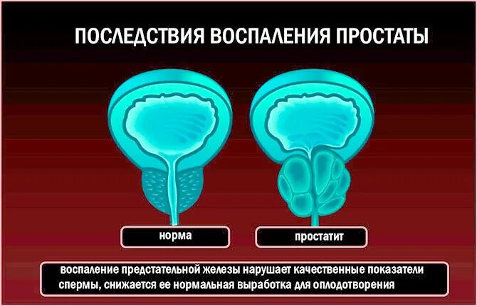 Последствие простаты. Воспаление предстательной железы. Хронический простатит.