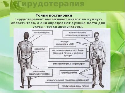 Как правильно ставить пиявок схема