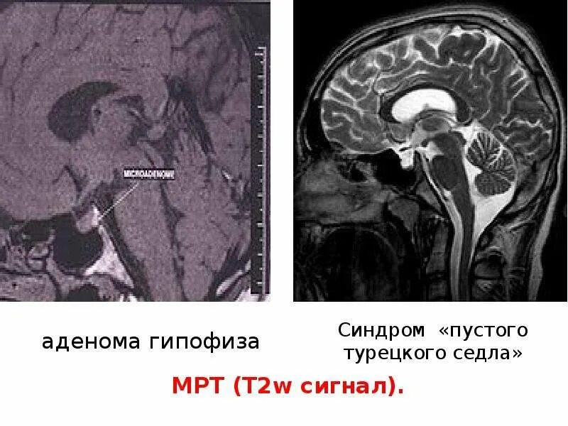 Формирующееся пустое турецкое седло головного. Гипофиз и турецкое седло на мрт. Эозинофильная аденома гипофиза кт. Инфраселлярный рост аденомы гипофиза. Аденома гипофиза головного мозга что это такое.