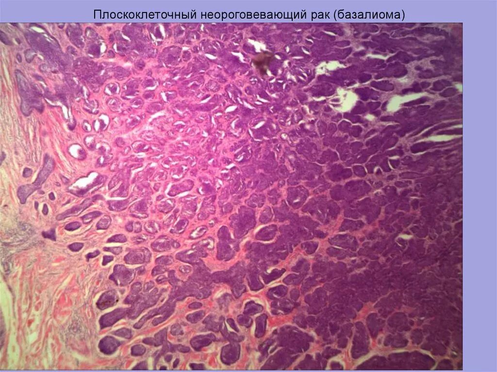 Опухолевидная базалиома. Фиброзирующая базалиома. Плоскоклеточная базалиома. Плоскоклеточный неороговевающий рак шейки