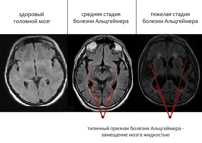 Признаки атрофии головного мозга. Кт и мрт при болезни Альцгеймера. Болезнь Альцгеймера снимки мрт. Мрт головного мозга болезнь Альцгеймера. Кт признаки болезни Альцгеймера.