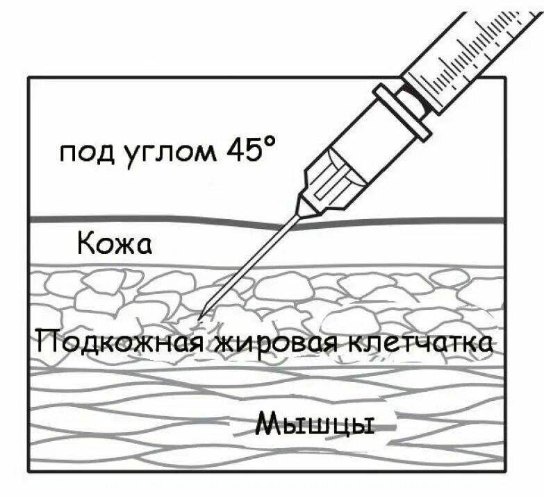 Подкожная глубина введения иглы. Подкожная инъекция угол введения иглы. Угол введения иглы при внутрикожной инъекции. Введение иглы при подкожной инъекции. Внутрикожная инъекция схема.