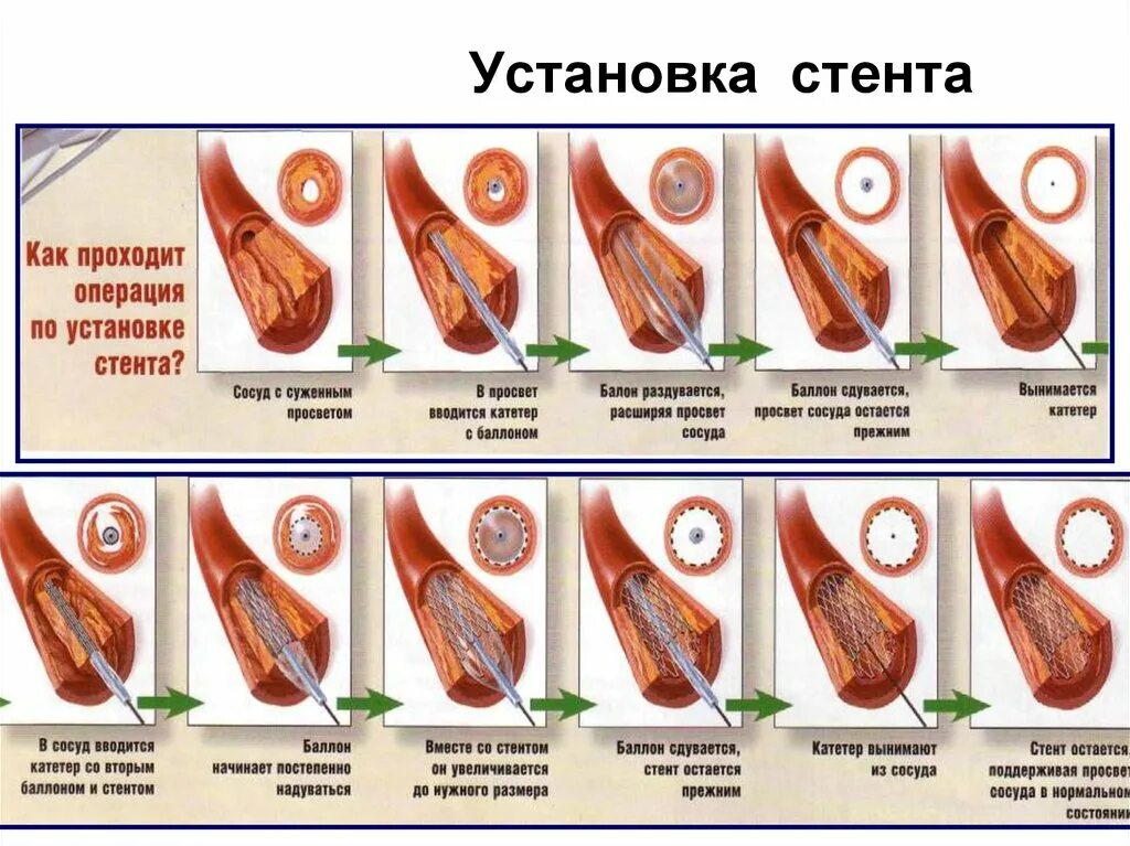 Лекарственный стент. Классификация стентов коронарных. Виды коронарных стентов с лекарственным покрытием. Типы стентов для коронарных сосудов. Стенты для коронарных сосудов с лекарственным покрытием.