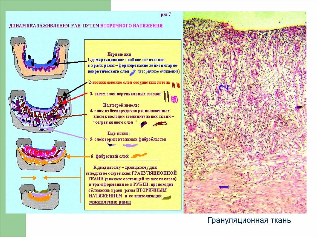 Этапы заживления ран. Строение грануляционной ткани патанатомия. Стадии образования грануляционной ткани. Слои грануляционной ткани патанатомия. Структура грануляционной ткани.