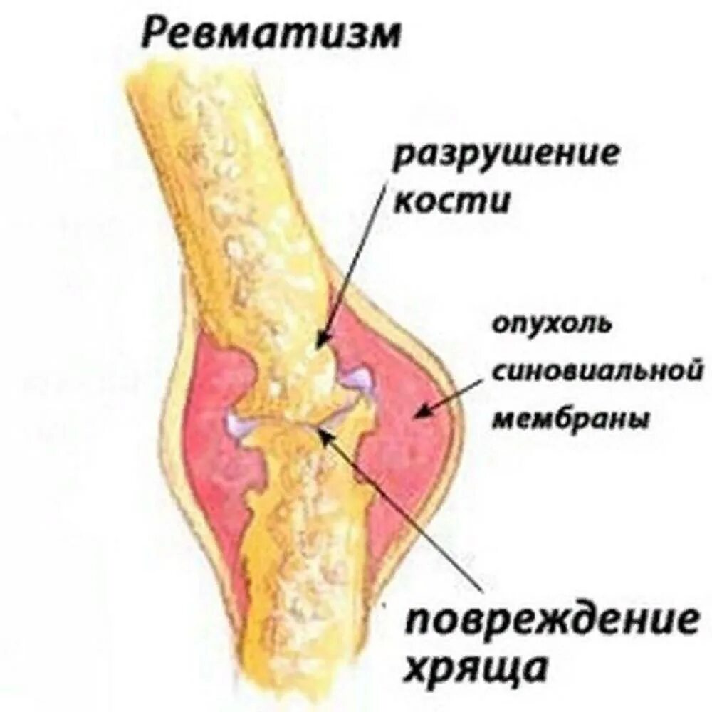 Ревматическое поражение суставов. Ревматизм поражение суставов. Ревматизм воспаление суставов.