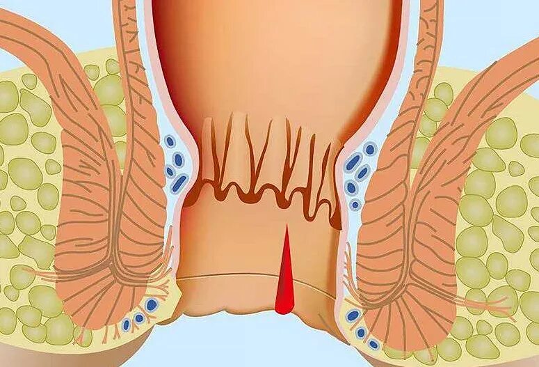 Ощущение в прямой кишке. Внутрикишечный геморрой. Анальная трещина сторожевой бугорок. Анальная трещина у женщин.