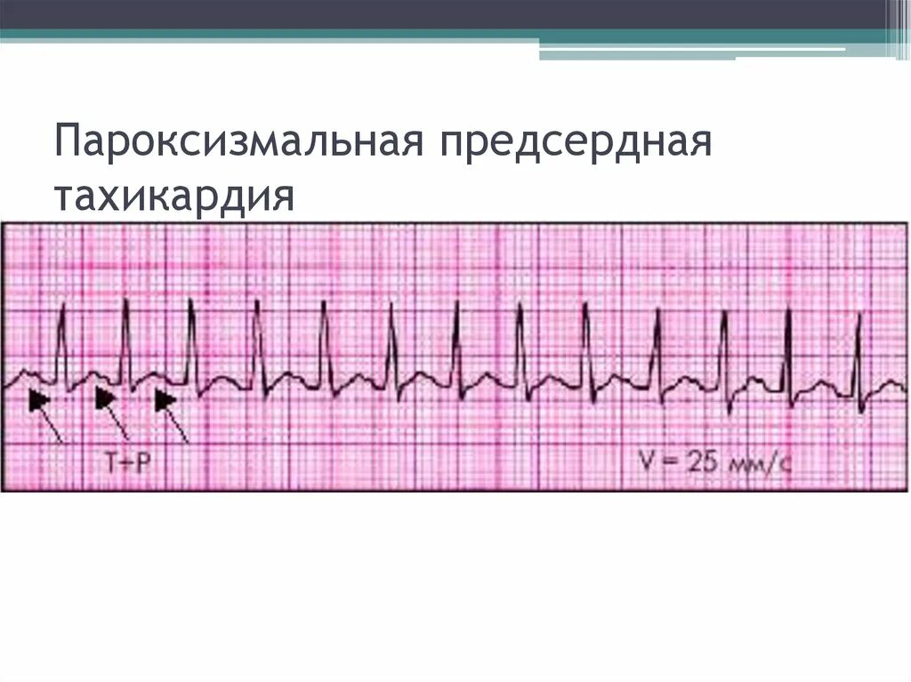 Суправентрикулярная тахикардия (свт) экг. Предсердная тахикардия на экг. Фокусная предсердная тахикардия. Фокусная предсердная тахикардия. Предсердная тахикардия на экг признаки.