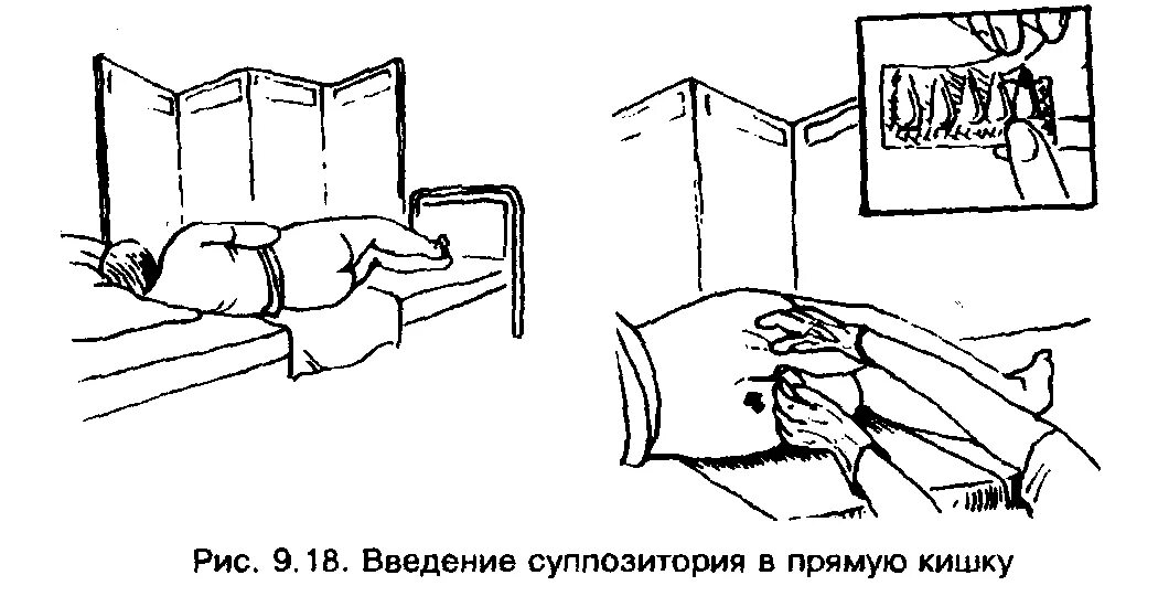 Ректальный метод. Введение суппозитория (свечи) в прямую кишку. Введение лекарственных веществ через прямую кишку. Введение лс через прямую кишку. Ректальный путь введения суппозиторий.