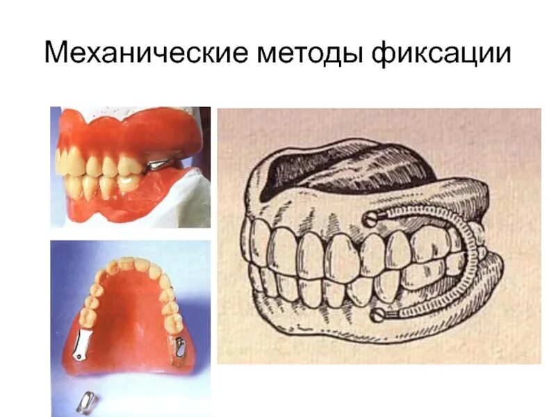 Методы фиксации съемных. Механические методы фиксации полных съемных пластиночных протезов. механические методы фиксации протеза. биомеханический метод фиксации протезов. механический метод фиксации съемных протезов.