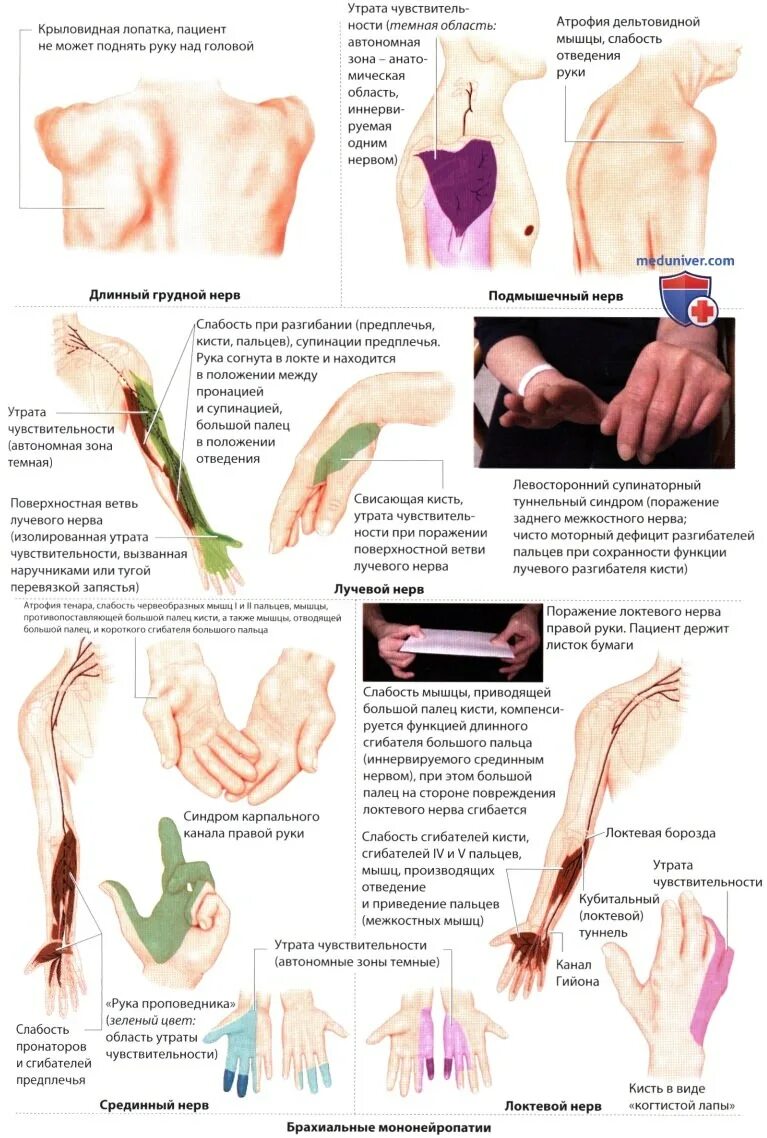 Периферийная нейропатия симптомы. Нейропатии лучевого нерва. Невропатия надлопаточного нерва. Туннельный синдром лучевого нерва.