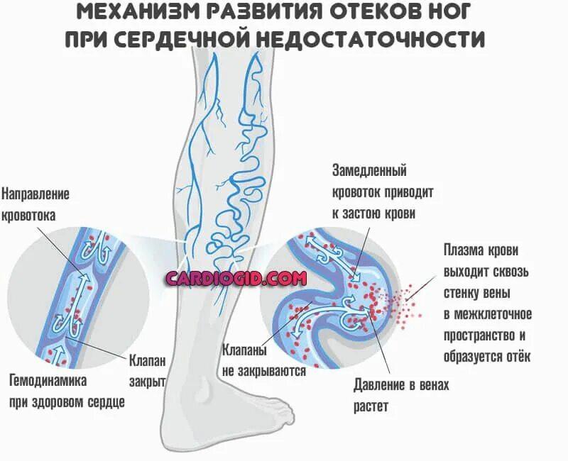 Лимфореей это. Механизм развития отеков ног при сердечной недостаточности. Варикозное расширение вен нижних конечностей стадии развития. Отек конечностей при ХСН. Варикозное расширение вен патогенез.