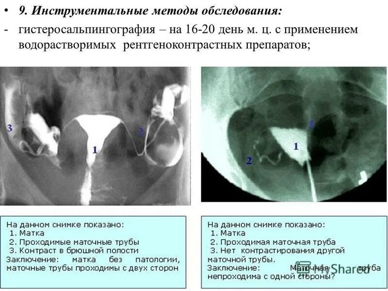 ГСГ снимок маточных труб рентген. Гистеросальпингография маточных труб контрастное вещество. Снимок проходимости маточных труб расшифровка. Гистеросальпингография УЗИ. Месячные после удаления трубы