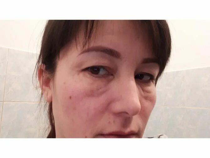 Отекаю после ботокса. Отеки после ботокса под глазами. отек лица после ботокса.