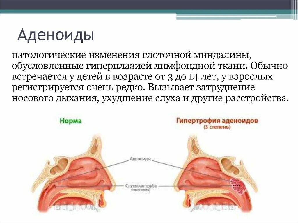 Аденоиды у ребенка 2 3 лет. Строение носоглотки аденоиды. Гипертрофия аденоидов II-III степени. Гипертрофия глоточной миндалины аденоиды. Гипертрофия носоглоточной миндалины (аденоиды).