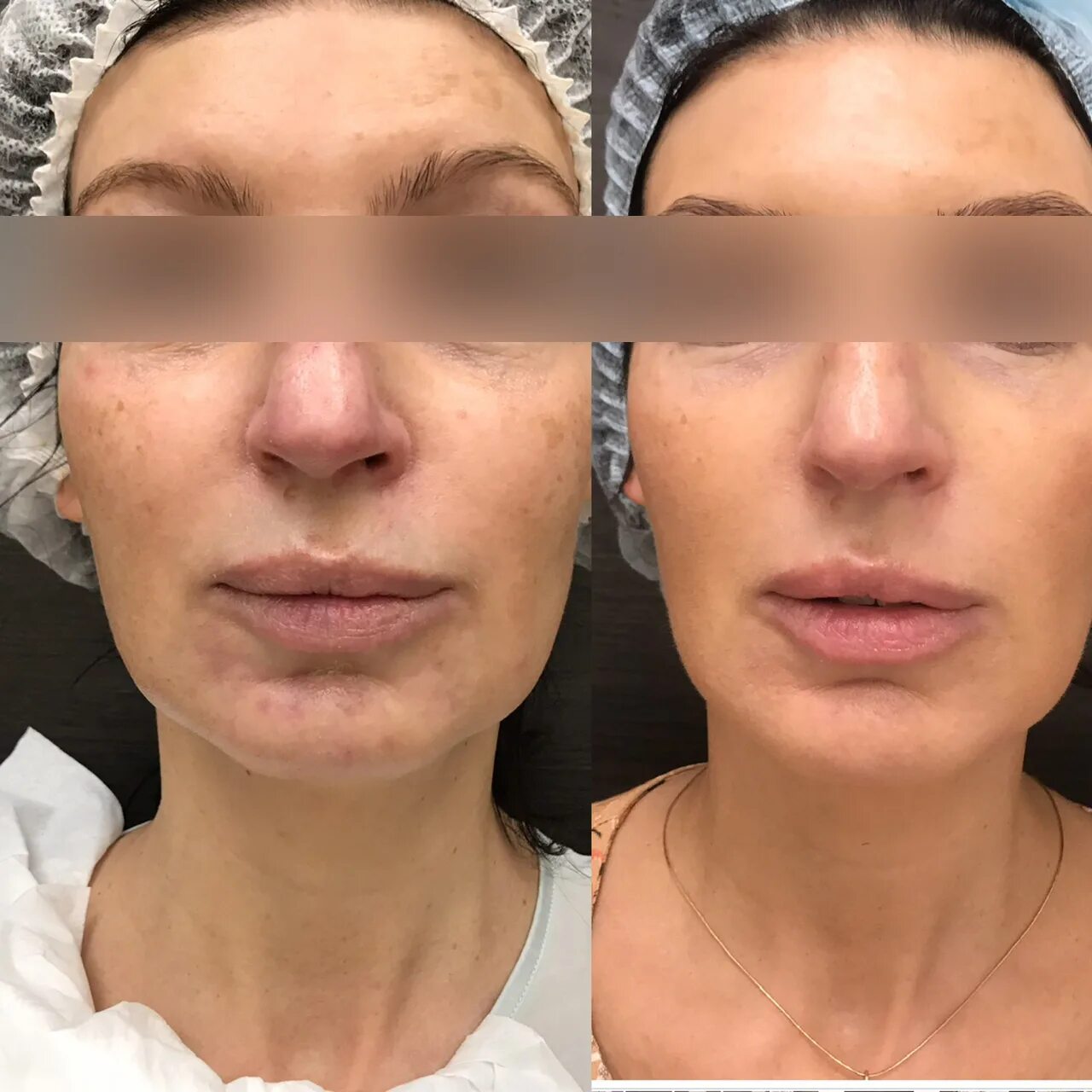 Контурная пластика лица skinlift. Скульптра Sculptra до и после. Контурная пластика Естелин. Контурная пластика рестилайн. До и после контурной пластики лица.