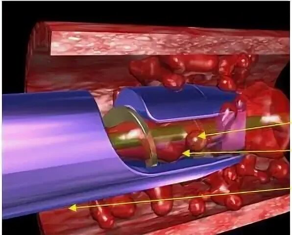 Артерия тромб удаление