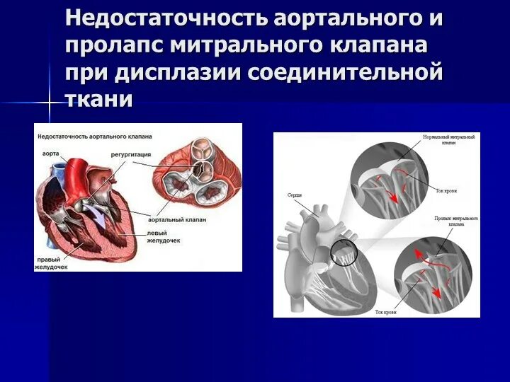 Что такое пролапс митрального клапана. Дисплазия створки митрального клапана. Пролапс двустворчатого клапана. Пролапс створок аортального клапана.