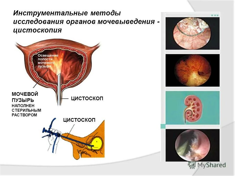 Цистоскопия у детей