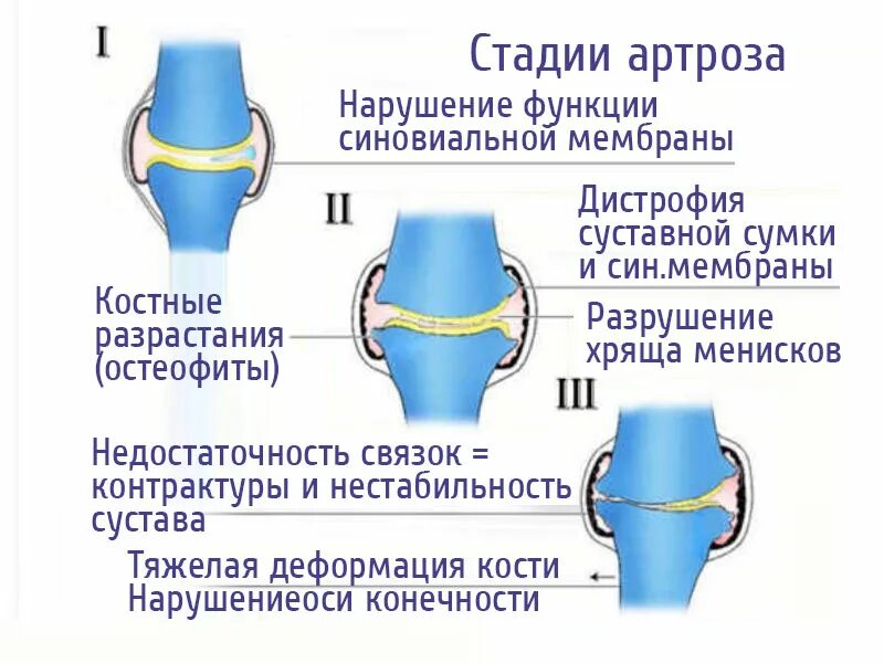 Дегенерация мениска. Степени артроза коленного сустава. Схема развития деформирующего остеоартроза.