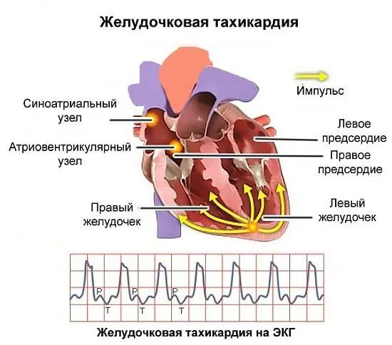 Расширен комплекс qrs на экг. Экг при наджелудочковой и желудочковой пароксизмальной тахикардии. Тахикардия сердца желудочковая. Желудочкова яаритмия эуг. Желудочковая тахикардия сердце.