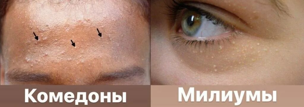 Файл:Blackheads.JPG - Википедия