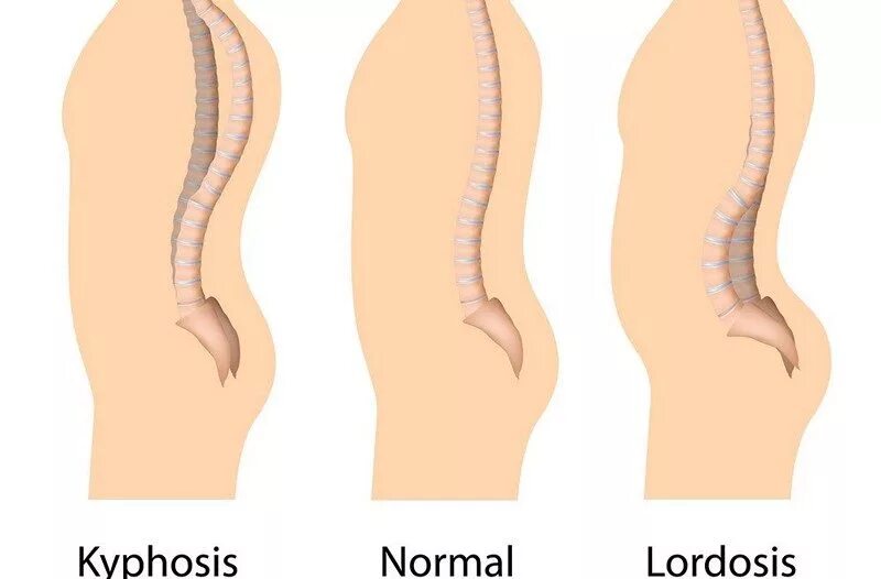 Лордоз и кифоз. Лордоз грудного отдела кифоз поясничного. Искривление позвоночника кифоз и лордоз. Лордоз кифоз сколиоз.