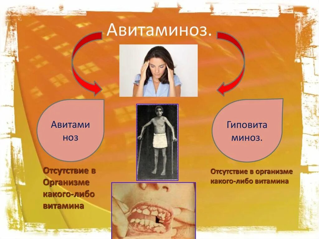 Авитаминоз. Авитаминоз презентация. Авитаминоз авитаминоз.