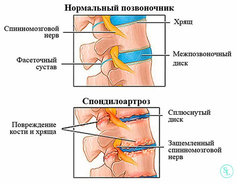 Куда отдает боль грыжа