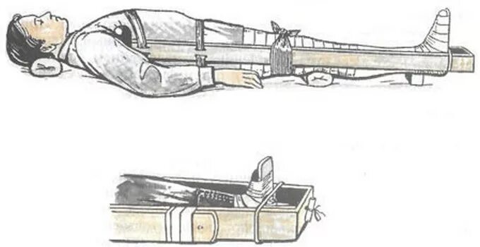 Шок при множественных переломах. Травматический ШОК транспортная иммобилизация. Транспортная иммобилизация при шоке. Вывихи бедра иммобилизация шиной Дитерихса. Травматический ШОК транспортировка пострадавших.