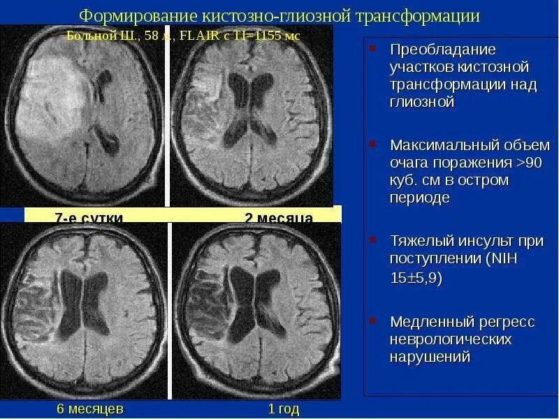 Признаки глиозных изменений