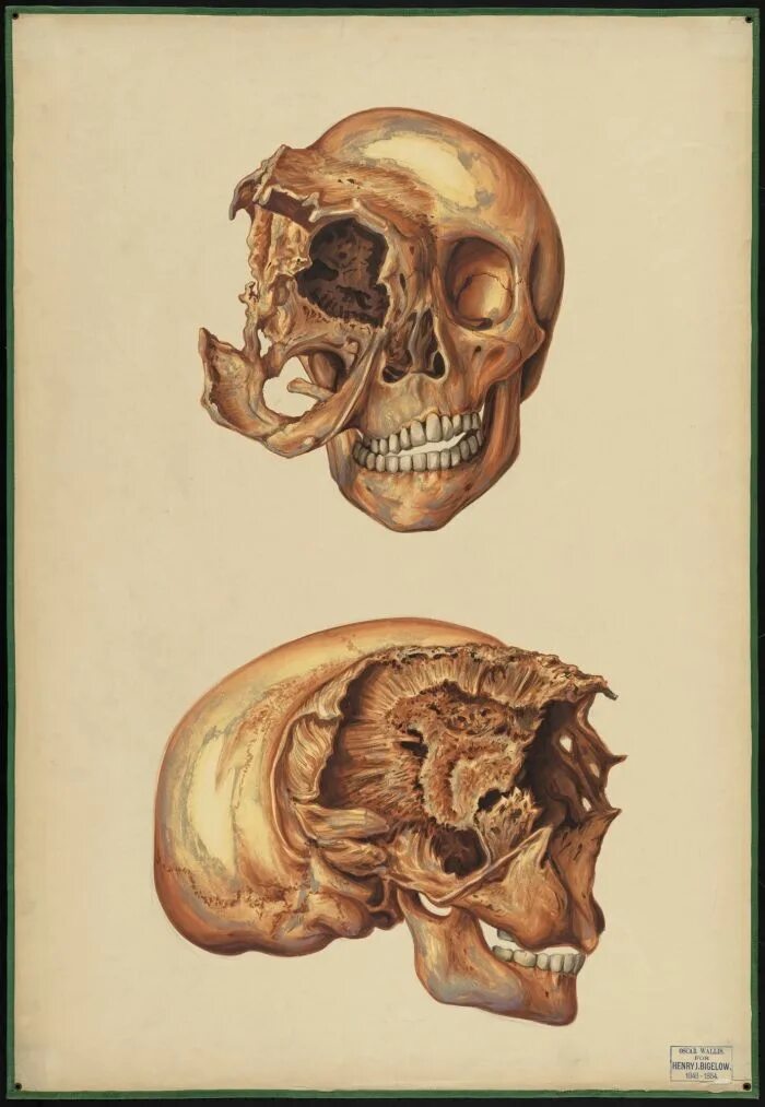 Череп разрыв. Остеосаркома костей черепа. Деформированный человеческий череп.