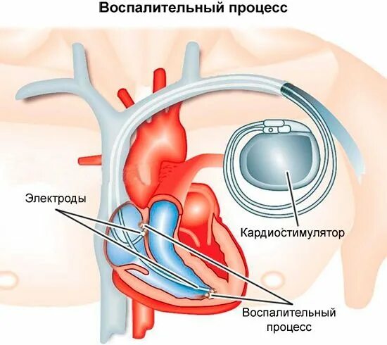 Электростимулятор сердца. Имплантация электрокардиостимулятора. Кардиостимулятор сердца. Почему в инструкции людям с кардиостимуляторами запрещается