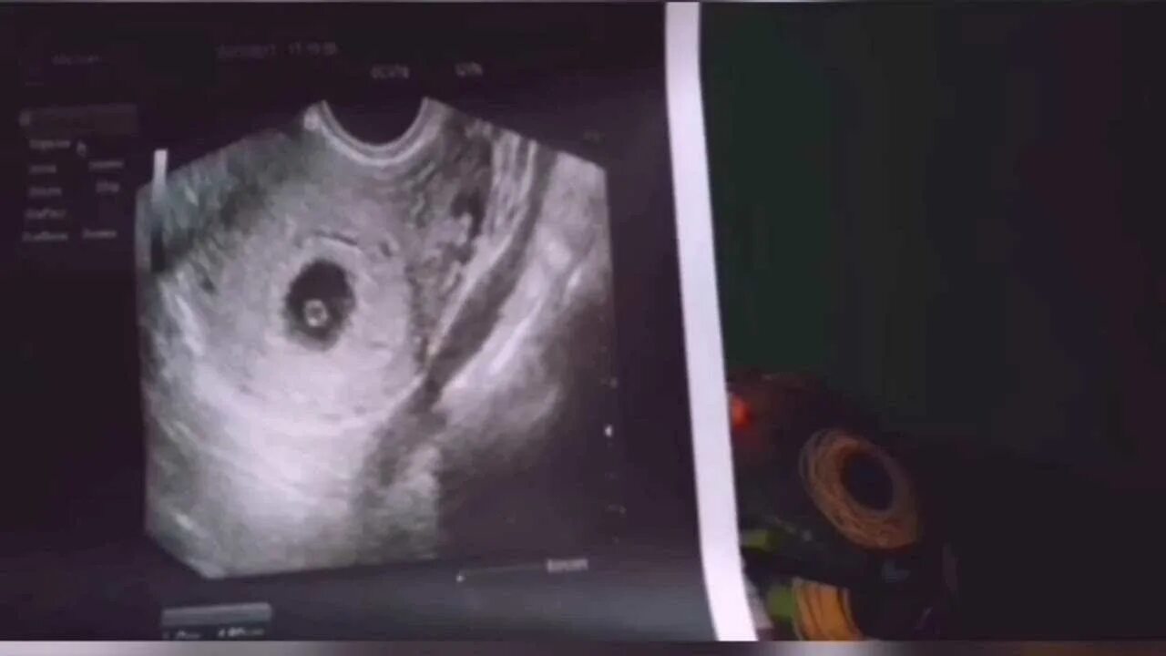 замершая беременность на раннем сроке. пустое плодное яйцо на узи. планирование беременности после замершей. подготовка к беременности после замершей беременности. замершая беременность на раннем сроке.