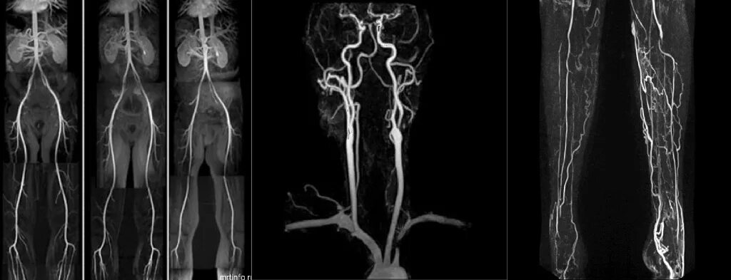 Кт ангиография сосудов головного мозга. Магнитно-резонансная венография головного мозга. Мрт ангиография сосудов головного мозга. Мрт ангиография артерий головного мозга.