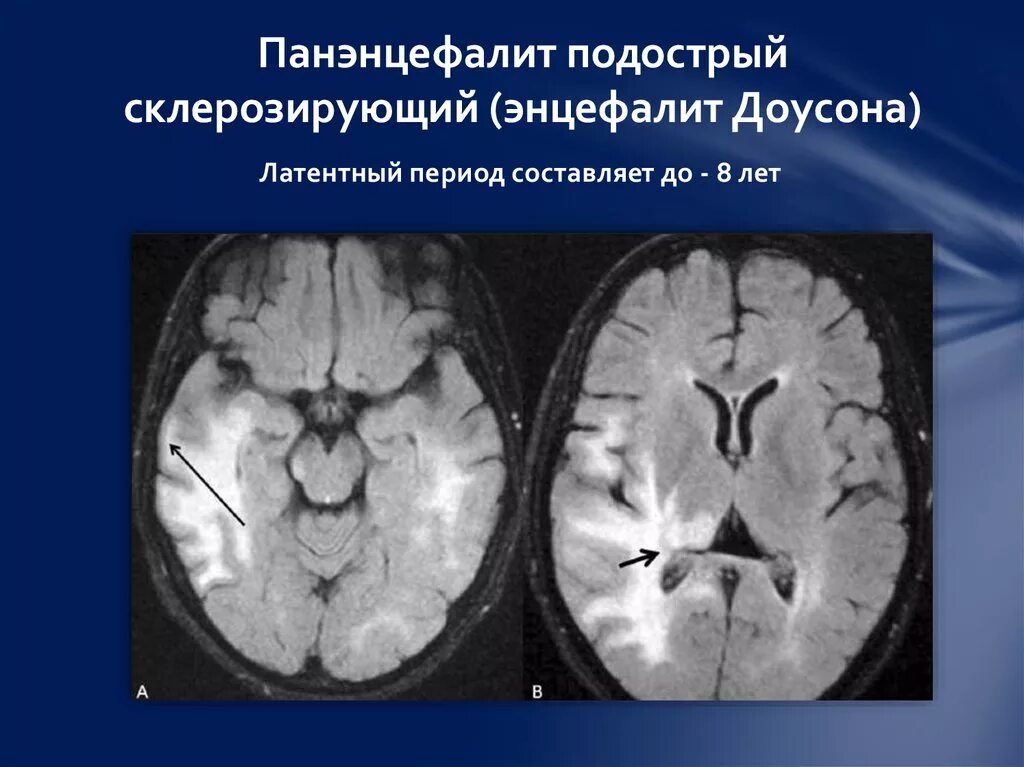 Подострый склерозирующий панэнцефалит мрт. Подострый коревой склерозирующий панэнцефалит. Коревой панэнцефалит мрт. Энцефалит головного мозга у взрослых