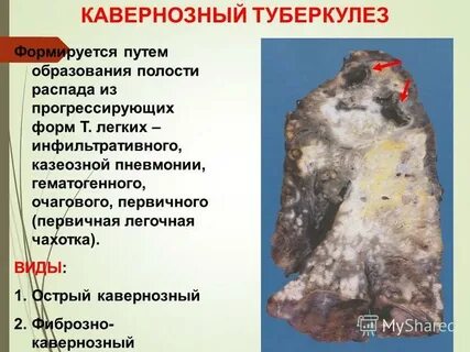 Полость при туберкулезе легких