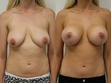 Before & After Breast Augmentation Case 57 View #1 View in Gilbert, AZ.