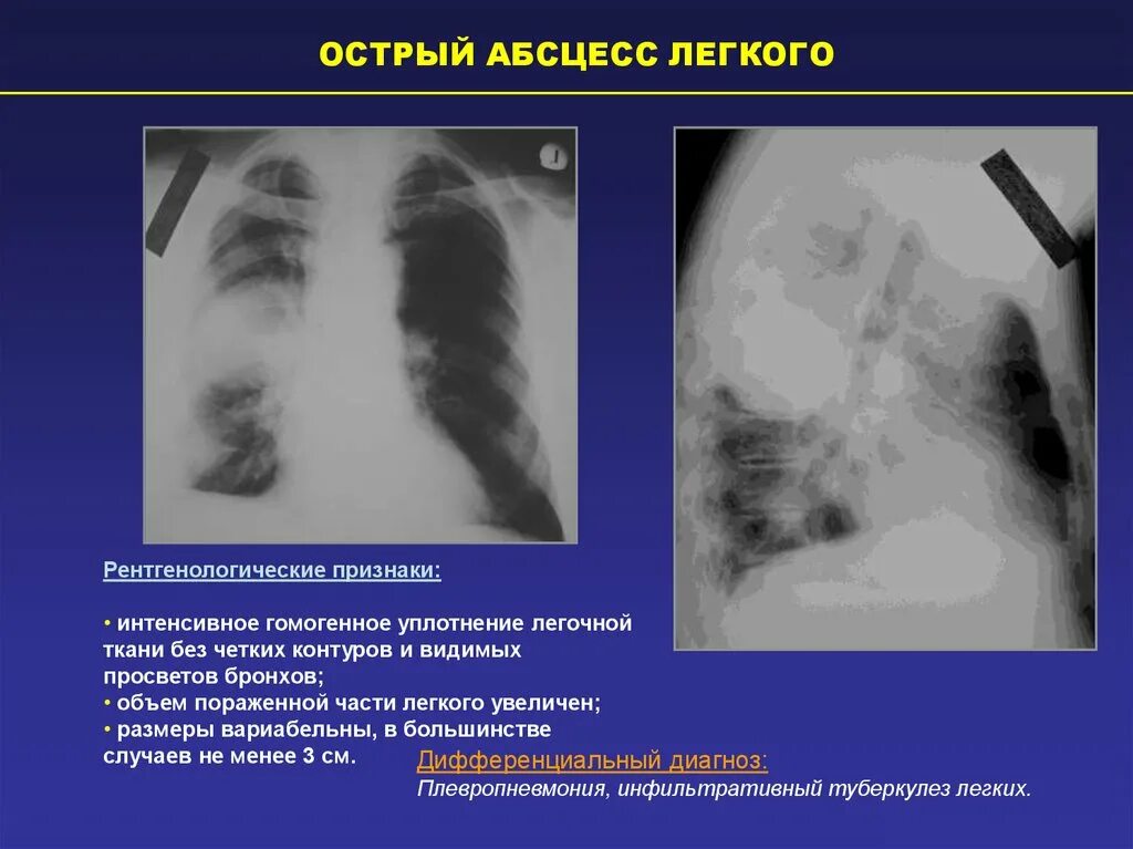 Рентгенологические признаки абсцесса легкого. Основной рентгенологический признак абсцесса легкого. Абсцесс легкого рентген признаки. Абсцесс легкого рентген дренирование. Острое поражение легких