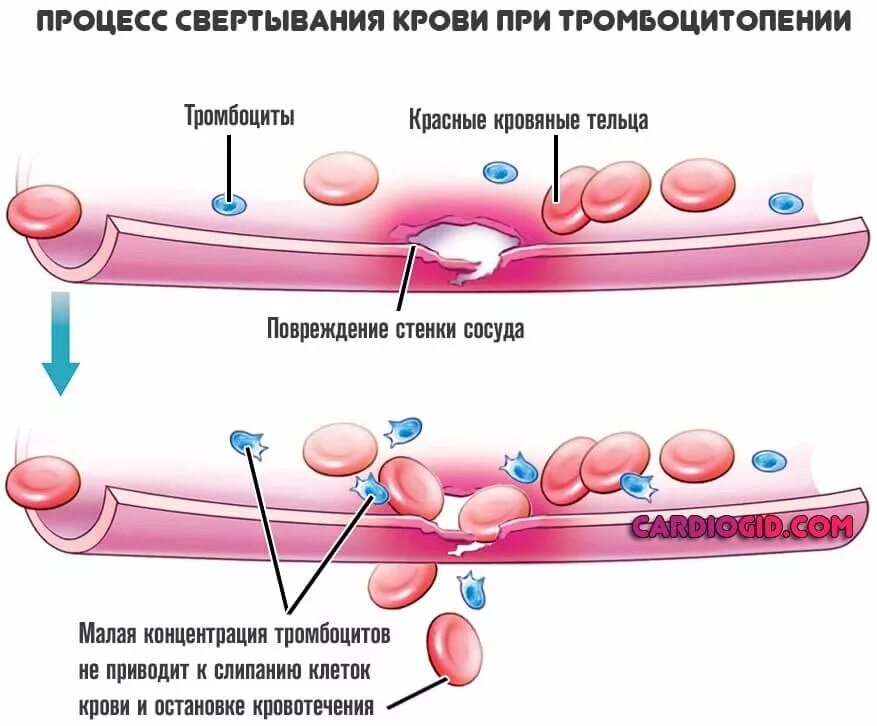 Тромбоцитопения кровотечение. Процесс свертывания крови при тромбоцитопении. Нарушение свертываемости крови тромбоцитопения. Иммунная тромбоцитопения сыпь. Наоузение свёртываемости крови.