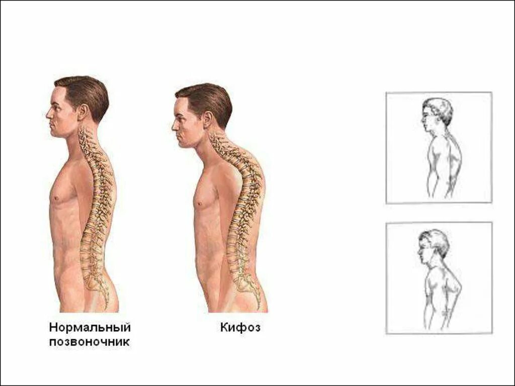 Кифоз грудного отдела позвоночника. Спина лордоз и кифоз. Позвоночник человека лордоз кифоз. Лордоз кифоз сколиоз.