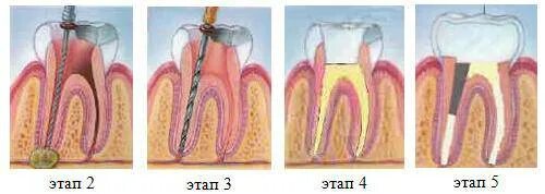 на сколько ставят мышьяк в зуб