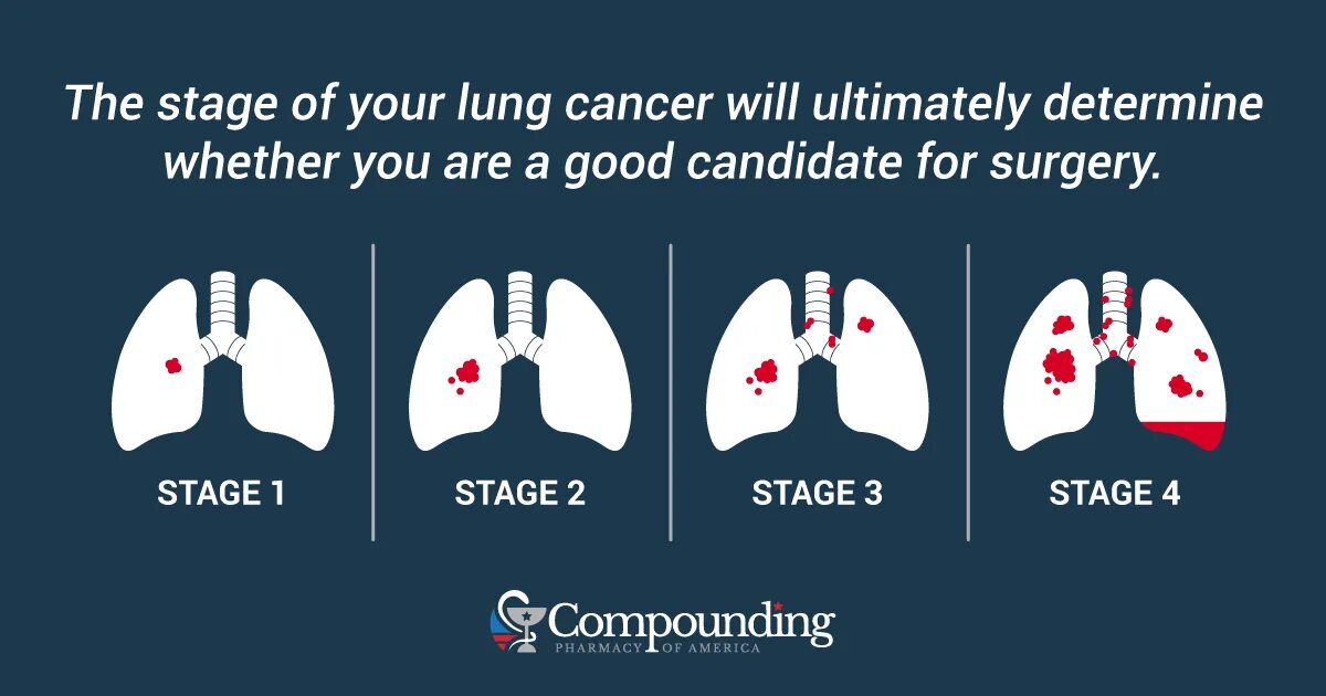 Lung Cancer classification. Lung Cancer сцинтиграфия. Stages of cancer