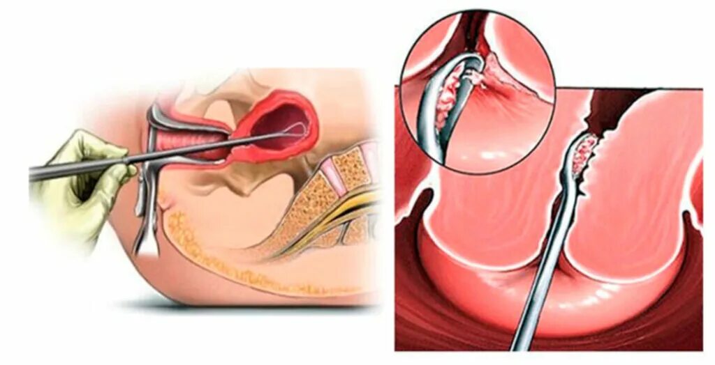 Кюретаж в гинекологии