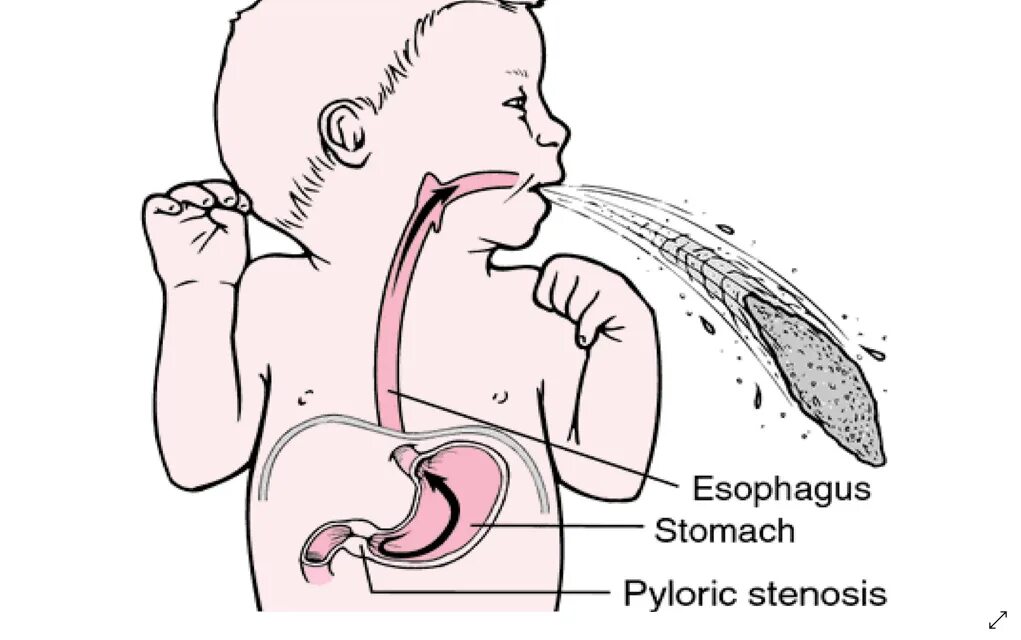 Пилороспазм и пилоростеноз у детей. Пилоростеноз и пилороспазм рентген. Пилоростеноз рвота фонтаном. Пилоростеноз у новорожденных.