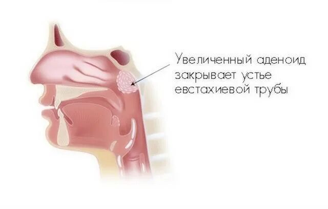 Аденоиды носоглотки 2 степени. Аденоиды 3 степени операция. Носоглотка аденоиды 3 степени.
