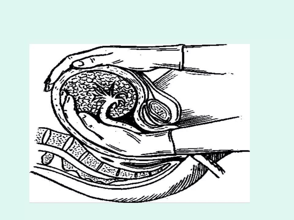 Ручное извлечение плаценты. Ручное отделение последа. Операция ручного отделения плаценты. Можно достать до матки