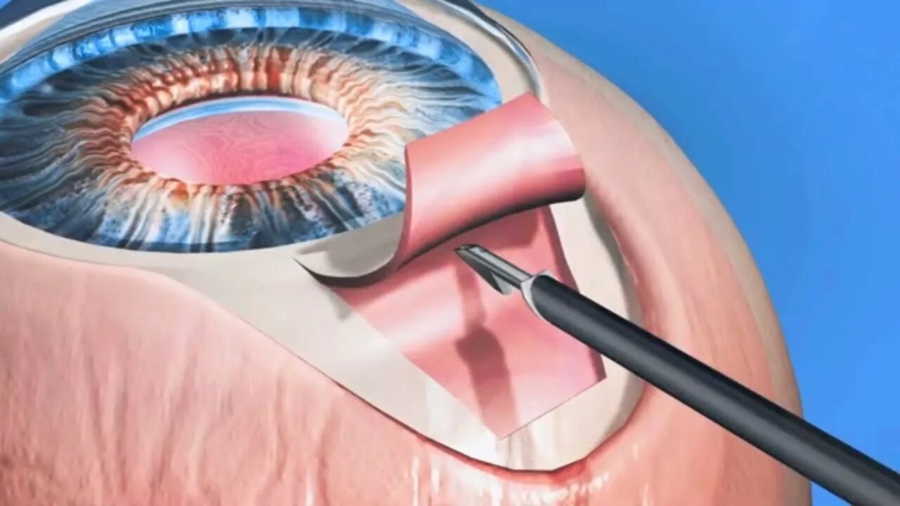 Непроникающая склерэктомия при глаукоме. Иридэктомия хирургическая. Хирургическая операция глаукомы. Глазная операция глаукомы