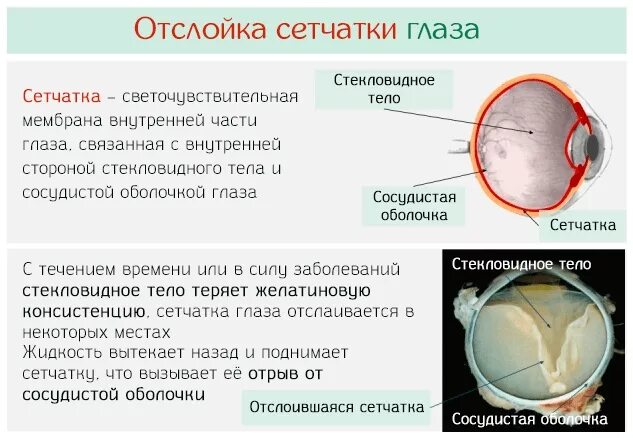 Отслоение сетчатки глазное дно. Регматогенная отслойка сетчатки симптомы. Причины первичной отслойки сетчатки. Назовите основные методы лечения отслойки сетчатки..