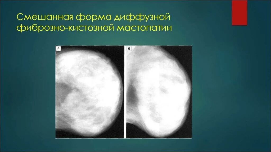 Диффузная фкм. Кистозная мастопатия маммография. фиброзно-кистозная мастопатия молочных желез рент. мелкоузелковый аденоз. диффузная фиброзная мастопатия молочных желез что это такое.