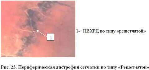 Дистрофия сетчатки улитки